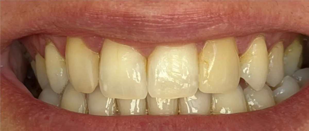 Antes: sorriso com dentes desgastados e formato irregular