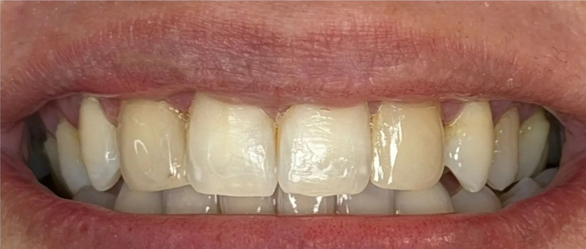 Depois: dentes com formato harmonioso após facetas em resina