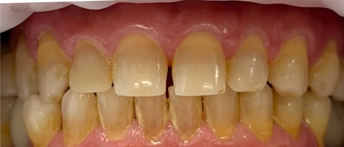 Antes: espaço entre os dentes da frente (diastema)