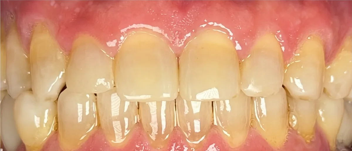 Depois: diastema fechado com resina