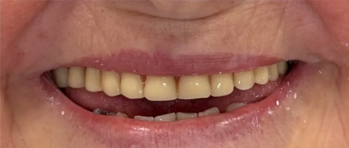 Antes: sorriso com próteses antigas e desgastadas