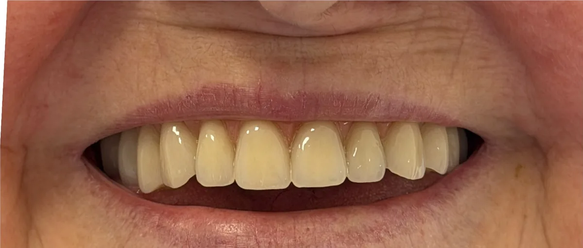 Depois: nova prótese com dentes alinhados